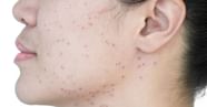 How To Remove Spots From Face In 2 Days Naturally Research Backed